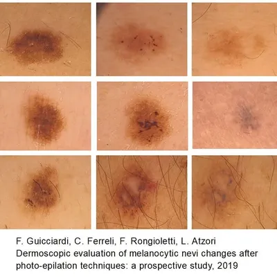 Меланома - рак кожи