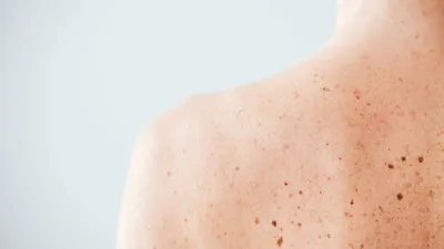 Диагностика новообразований кожи - Центр Европейской дерматологии