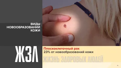 Удаление новообразований на лице и теле в СПб