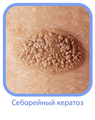 Удаление новообразований кожи лазером В Санкт-Петербурге