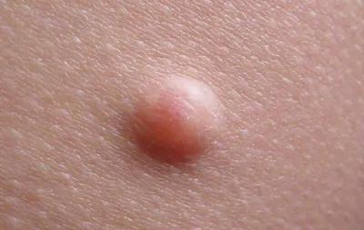 Лечение опухоли кожи в Москве - диагностика опухоли кожи в частной клинике  \"ВитаМед\".