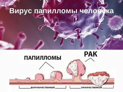 Удаление папиллом |