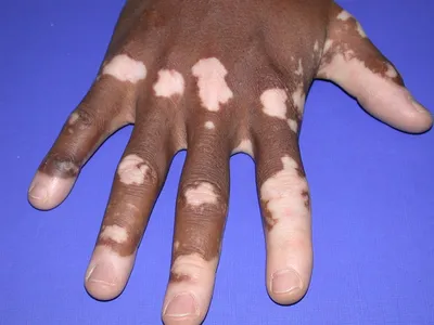 7 причин пигментации на коже | Ксения Чёрная PRO-Здоровье | Дзен