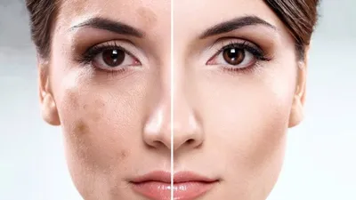 Фотоомоложение IPL: эффективное решение проблемы пигментации кожи