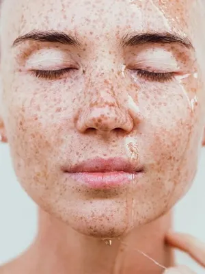 Гиперпигментация кожи - причины появления, при каких заболеваниях  возникает, диагностика и способы лечения