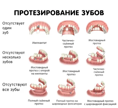 Виды протезирования зубов фото фото