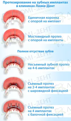 Протезирование зубов - Москва, Хирургическая стоматология на ВДНХ