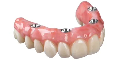 Протезирование зубов. Виды протезов, этапы протезирования