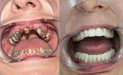 Мягкие зубные протезы: виды, цены на установку в Москве в клинике  эстетической стоматологии VIMONTALE