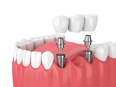 Протезирование верхних зубов, варианты и стоимость от 12 000 ₽