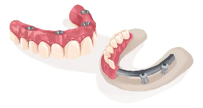 Виды протезирования зубов, какой зубной протез выбрать? - Статьи