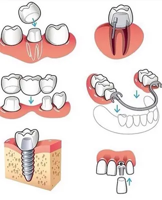 Съемные зубные протезы - виды, как выбрать и ухаживать? | Giorno Dentale