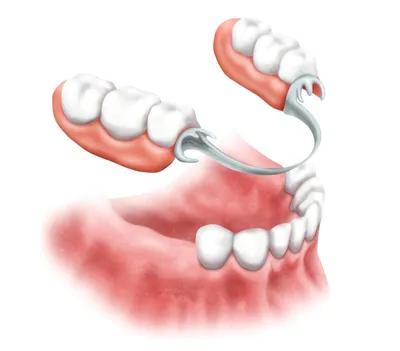 Полное протезирование зубов имплантами. Виды и цены в Ланри Клиник