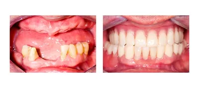 Протезирование зубов - что такое, виды протезов, какое лучше выбрать