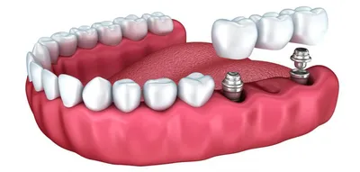 Протезирование зубов - цены, м.Полянка, Третьяковская Стоматология