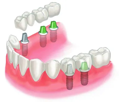 Виды протезирования зубов - плюсы и минусы