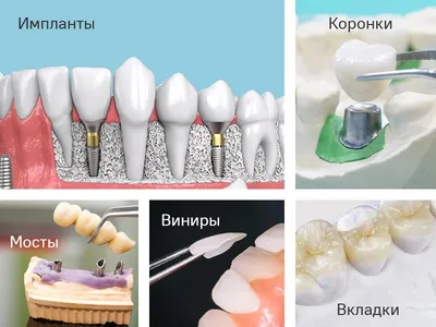 Несъемное протезирование зубов: новая и эффективная методика