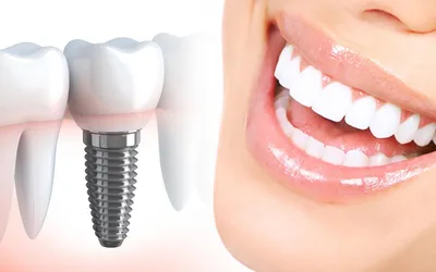 Протезирование зубов в Курске – цены на зубные протезы в Doctor Smile