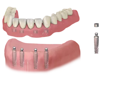 Виды протезирования зубов в стоматологии \"Дента Плас\"