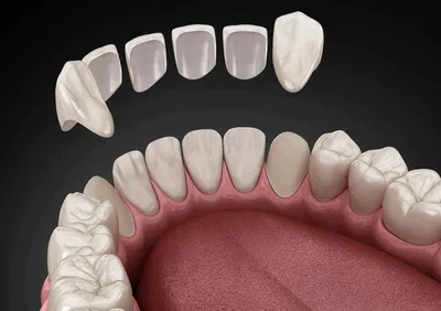 Протезирование при полном отсутствии зубов, виды зубного протезирования при  полной адентии | НоваДент