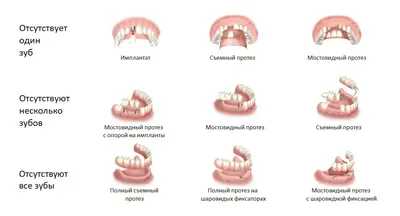 Протезирование зубов на имплантах в Краснодаре. Установка импланта зуба.  Цены в «Smile Clinic»