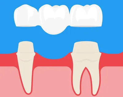 Протезирование зубов винирами | Стоматология Улыбка