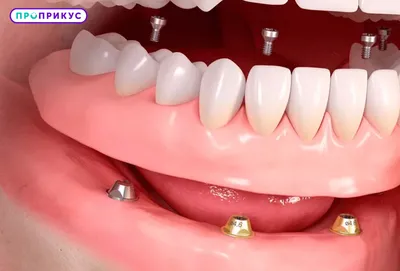 Протезирование зубов - виды протезирования и материалы. | Советы  стоматолога | Дзен