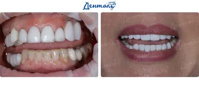 Виды протезирования зубов - Стоматология \"Алекс\" в Жуковском