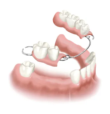 Полное протезирование зубов: виды протезов
