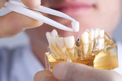 Виды протезирования зубов – что выбрать?