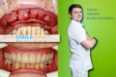 Протезирование зубов Тюмень - цена от 3708 руб.