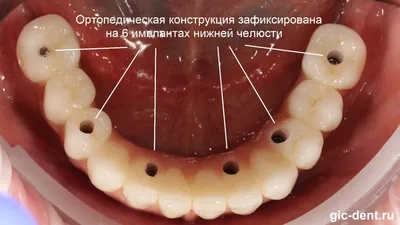 Протезирование зубов в Москве [показания и виды]