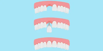 Протезирование зубов: виды конструкций и расчёт цены