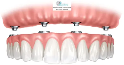 Протезирование зубов в Подольске | Стоматология Улыбка