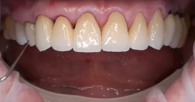 Особенности протезирование верхней челюсти при отсутствии зубов – Клиника ЕС