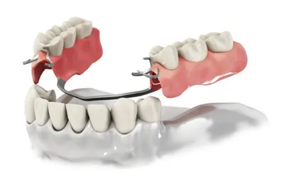 Какое протезирование зубов бывает. Съемные или несъемные протезы – что  лучше.