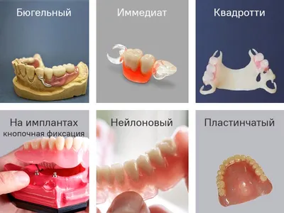 Виды протезирования зубов | Что подойдет именно вам