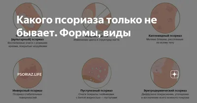 👉🏻Чаще всего псориаз ассоциируют с самой распространенной формой —  обыкновенным (вульгарным) псориазом. ☝🏼Но существуют и другие, более  тяжелые формы псориаза, которые встречаются реже. ❓Итак, какие же  существуют формы ? 1️⃣Обыкновенный ...