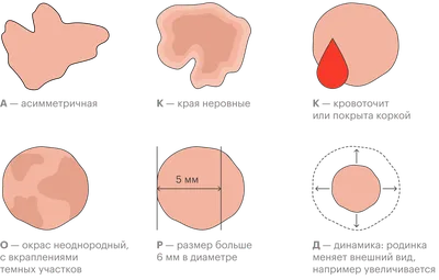 Родинки на теле: виды, какие опасны, профилактика меланомы