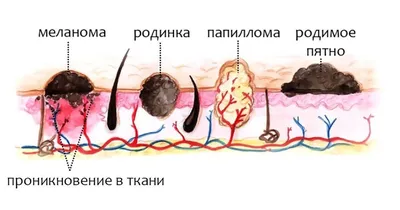 Невус: что это такое, почем возникает, в чем опасность и как лечить