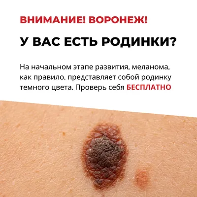 Что делать при изменении внешнего вида родинки? — Derma.ua