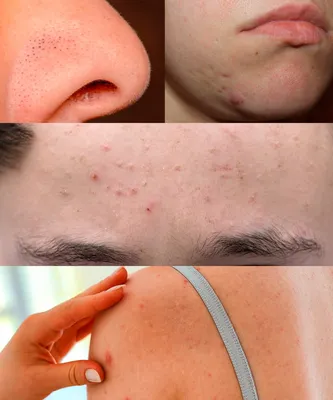 Белые точки на лице (милиумы) - как избавиться от угрей, причины появления  просянки, лечение кожи