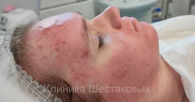 Угри прыщи лечение в клинике косметологии Москва