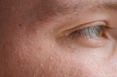 Белые точки на лице (милиумы) - как избавиться от угрей, причины появления  просянки, лечение кожи