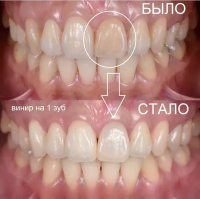 Как винир на 1 зуб помог вернуть красивую улыбку пациентке - Альянс  бьюти-стоматологов, Москва