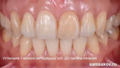 Как винир на 1 зуб помог вернуть красивую улыбку пациентке - Альянс  бьюти-стоматологов, Москва