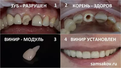 Установить виниры для зубов. Фото до и после, цена | Альянс  бьюти-ортопедов, Москва