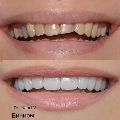 Как виниры исправили асимметрию улыбки у девушки – клиника Smile STD, Москва