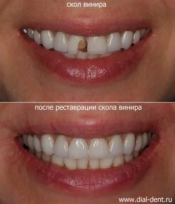 Виниры для зубов: цена в Москве на установку в стоматологии