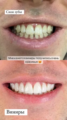 Виниры если нет части зубов можно поставить, но нужна подготовка - Немецкий  имплантологический центр, Москва